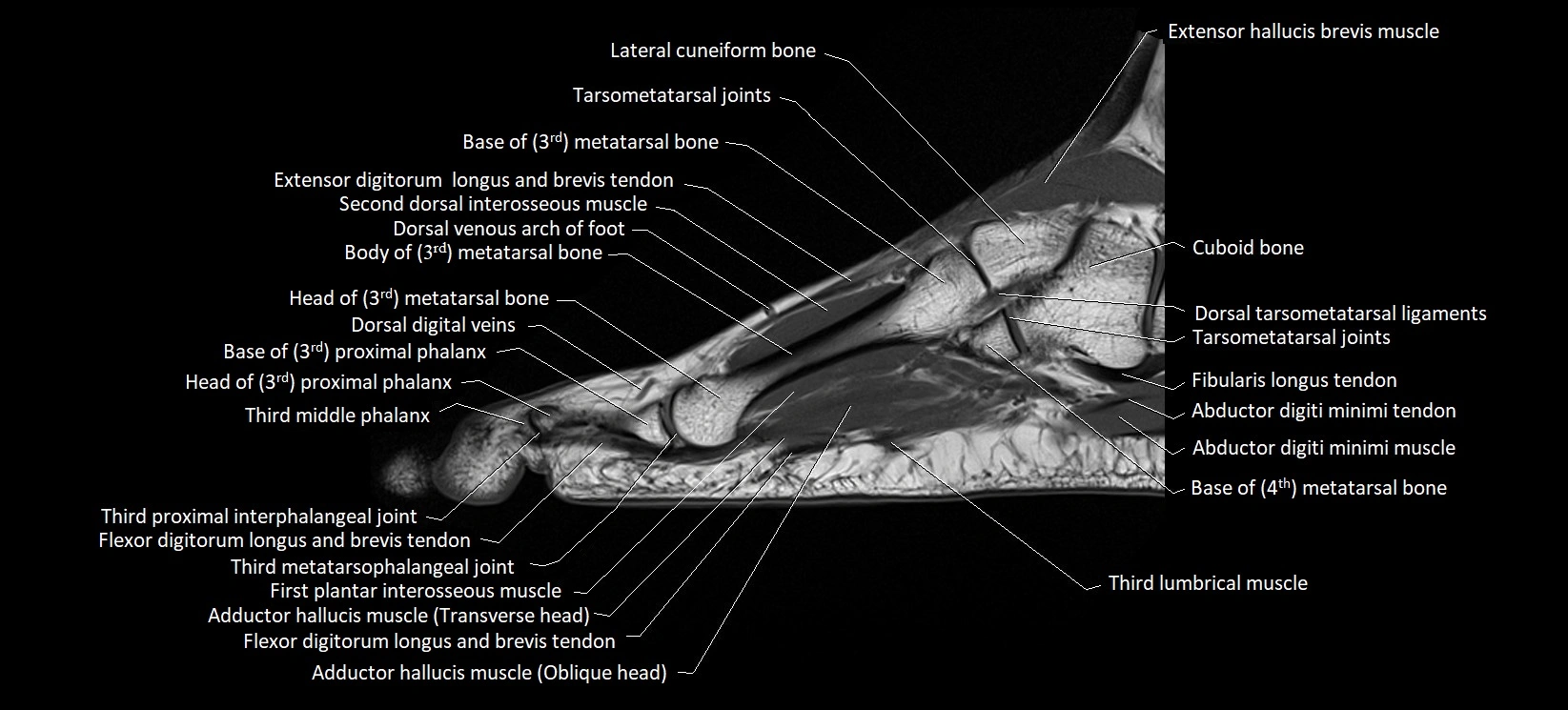MRI foot sagittal labelled cross sectional anatomy image  16.webp